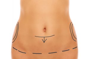 Abdominoplastia clássica