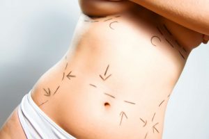 Abdominoplastia Extensa